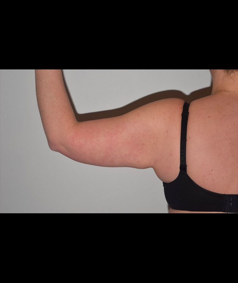 Body Contouring Before and After 17