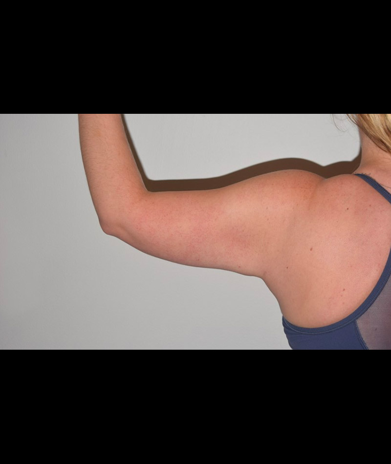 Body Contouring Before and After 09