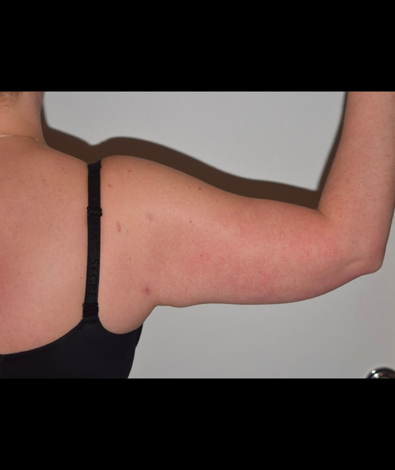 Body Contouring Before and After 17
