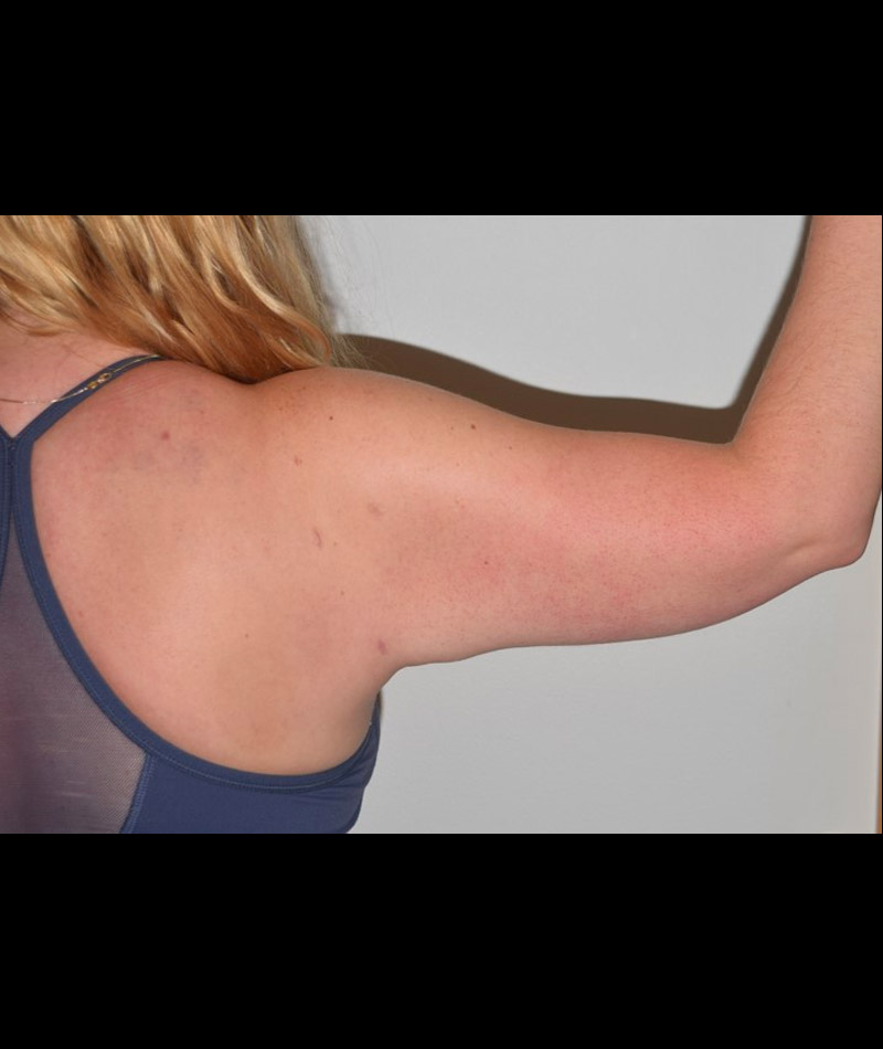 Body Contouring Before and After 17