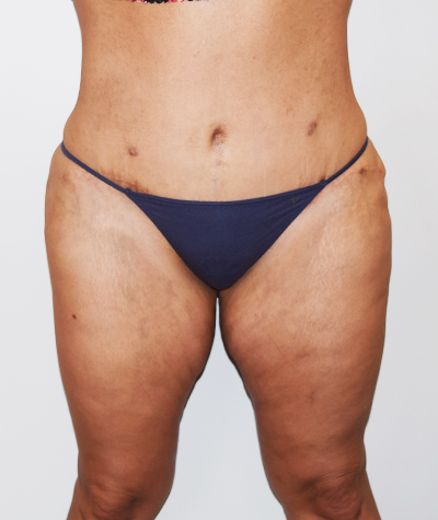 Body Contouring Before and After 18