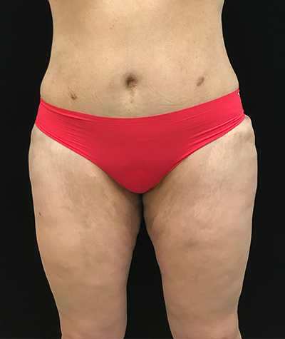 Body Contouring Before and After 09