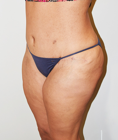 Body Contouring Before and After 18