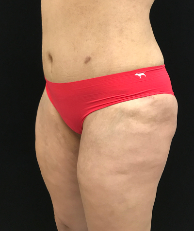 Body Contouring Before and After 18