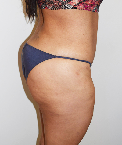 Body Contouring Before and After 18
