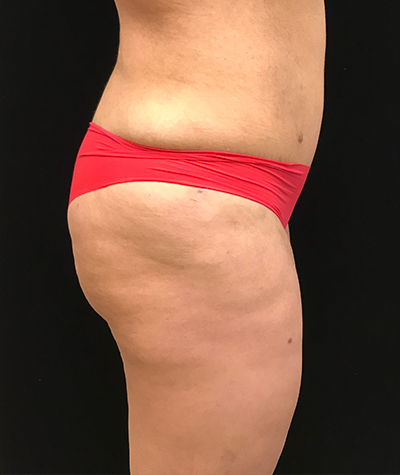 Body Contouring Before and After 18