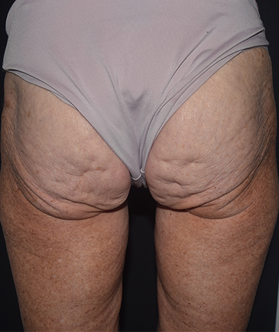 Body Contouring Before and After 19