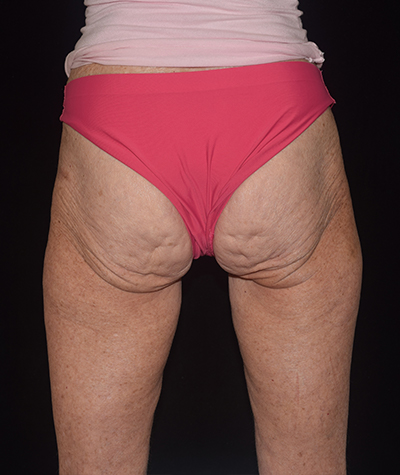 Body Contouring Before and After 19