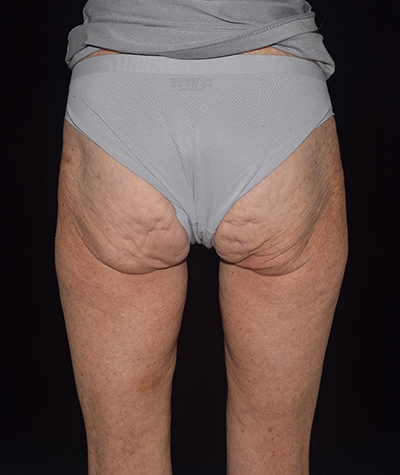Body Contouring Before and After 19