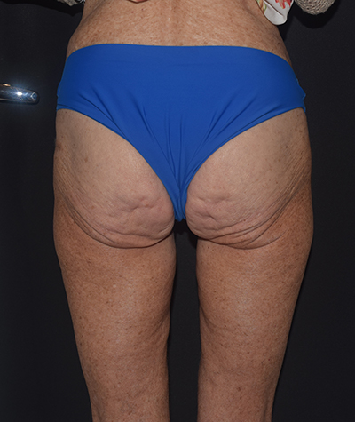 Body Contouring Before and After 19