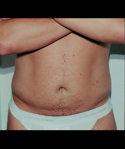 Liposuction Before and After 02