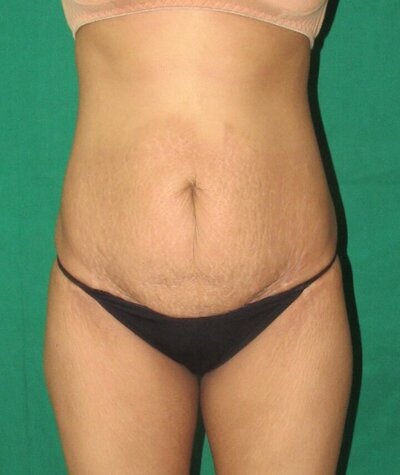 Tummy Tuck Before and After 01