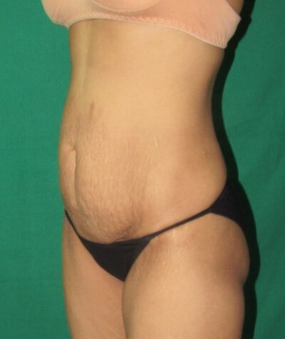 Tummy Tuck Before and After 01