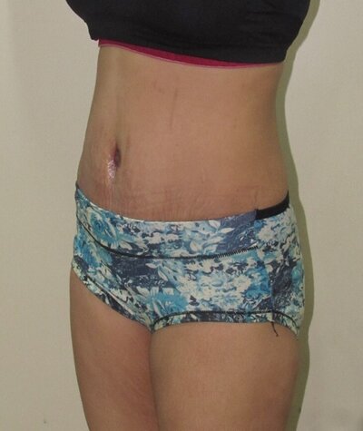 Tummy Tuck Before and After 01