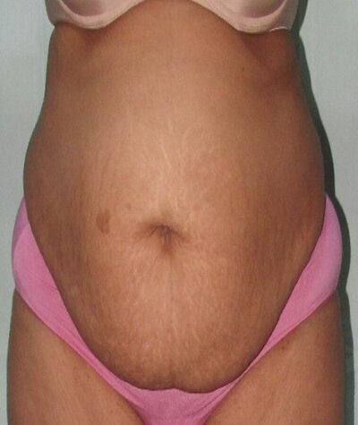 Tummy Tuck Before and After 02
