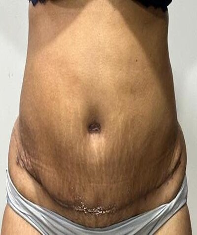 Tummy Tuck Before and After 06