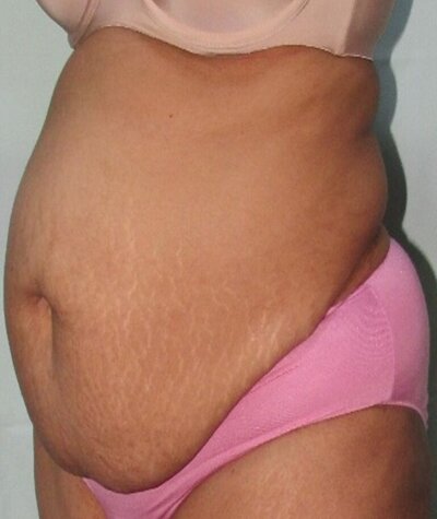 Tummy Tuck Before and After 02