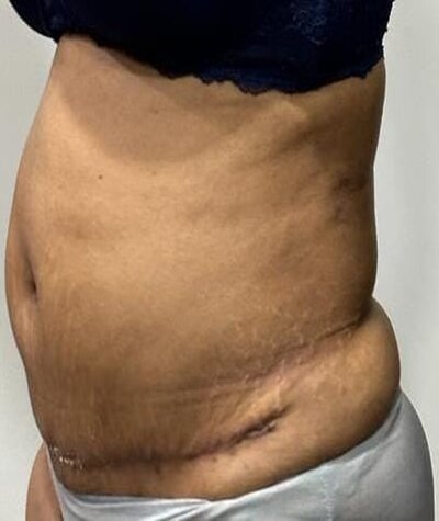 Tummy Tuck Before and After 02