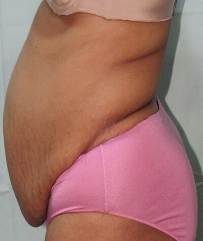 Tummy Tuck Before and After 02