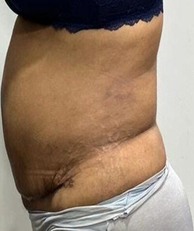 Tummy Tuck Before and After 02