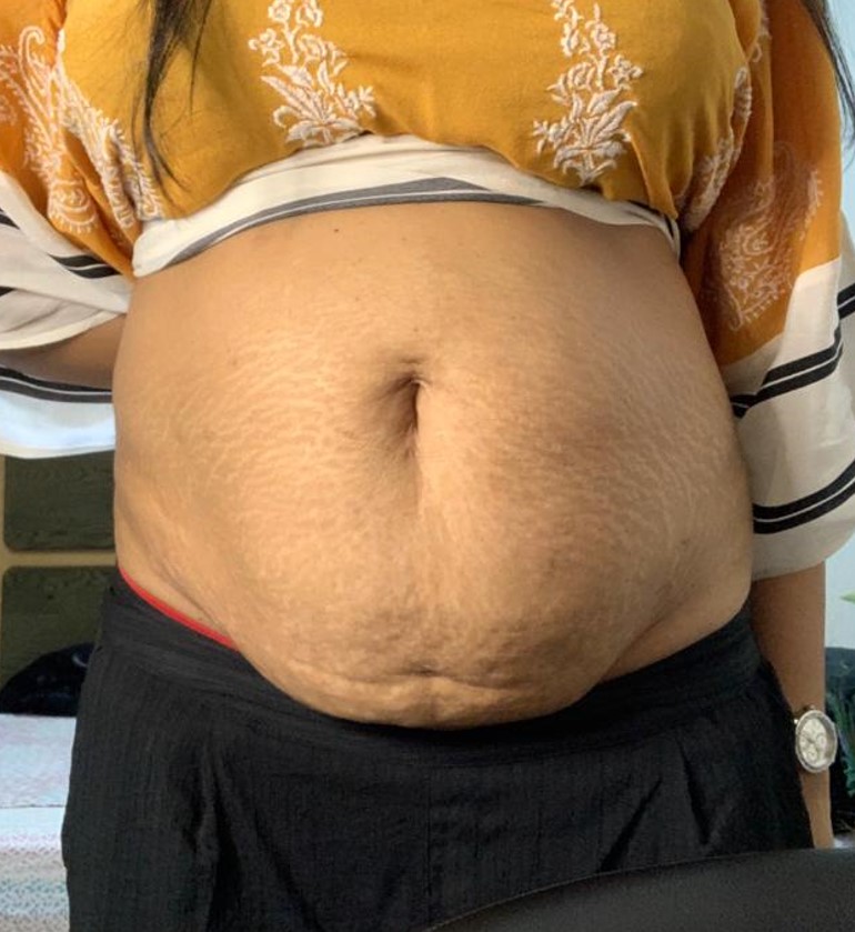 Tummy Tuck Before and After 03
