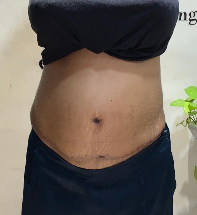 Tummy Tuck Before and After 06