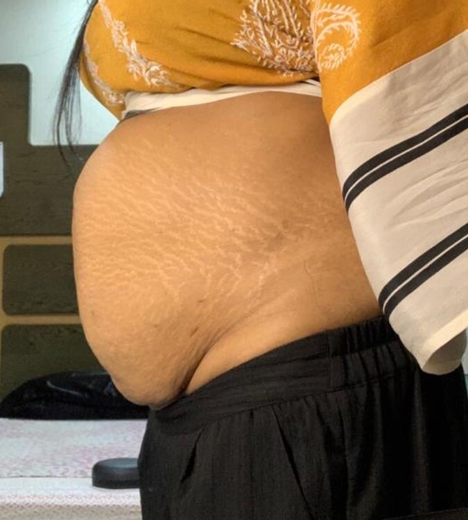 Tummy Tuck Before and After 03