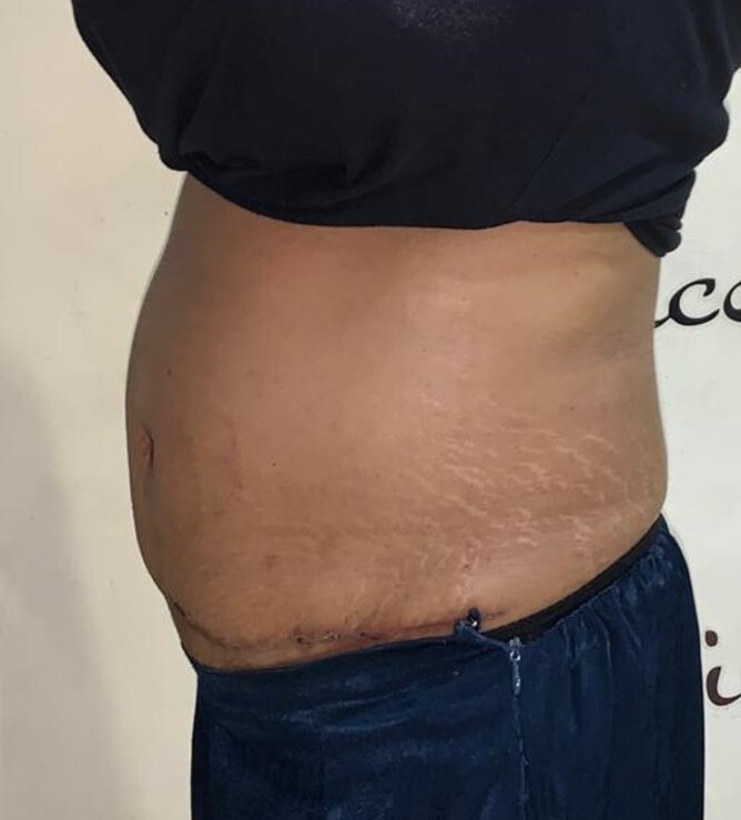 Tummy Tuck Before and After 03