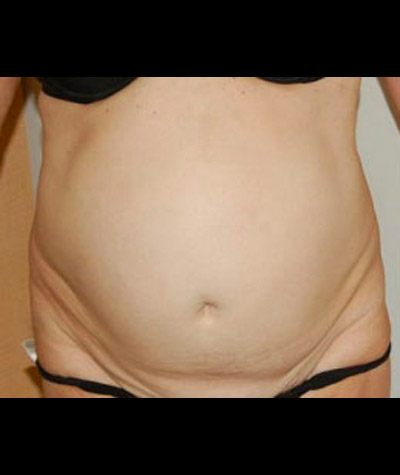 Tummy Tuck Before and After 04