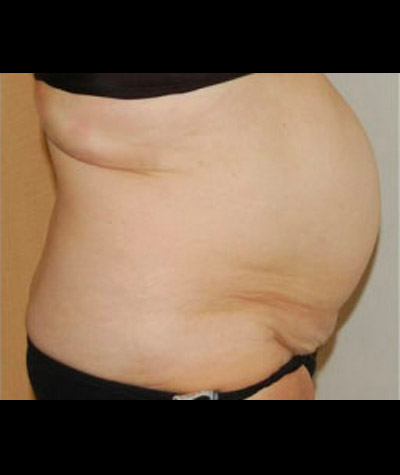Tummy Tuck Before and After 04