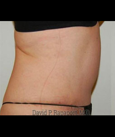 Tummy Tuck Before and After 04