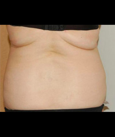 Tummy Tuck Before and After 04