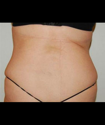 Tummy Tuck Before and After 04