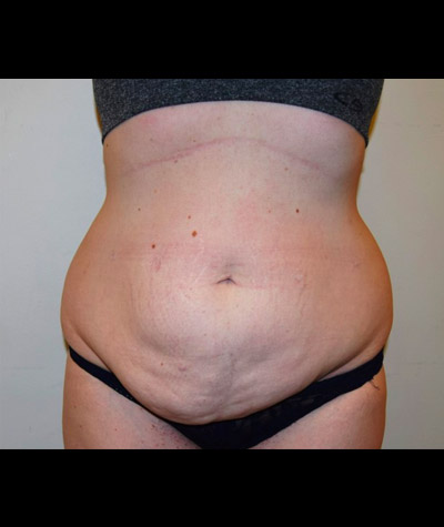 Tummy Tuck Before and After 05
