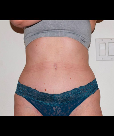Tummy Tuck Before and After 06