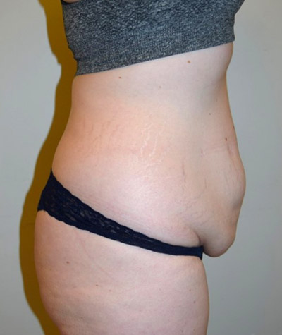 Tummy Tuck Before and After 05