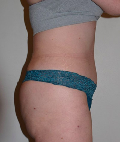 Tummy Tuck Before and After 05