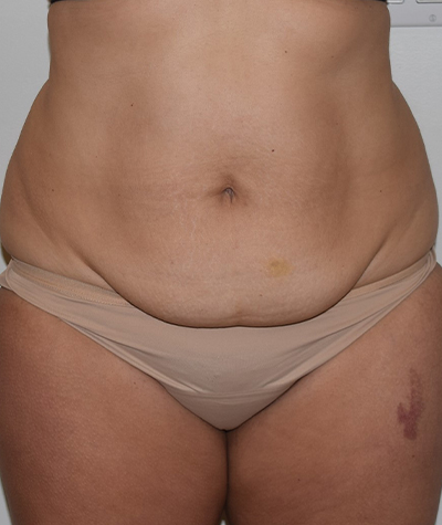 Tummy Tuck Before and After 06