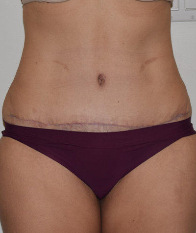 Tummy Tuck Before and After 06