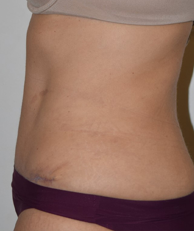 Tummy Tuck Before and After 06