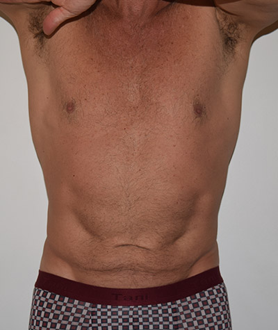 Tummy Tuck Before and After 07