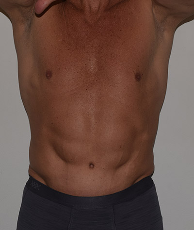 Tummy Tuck Before and After 06