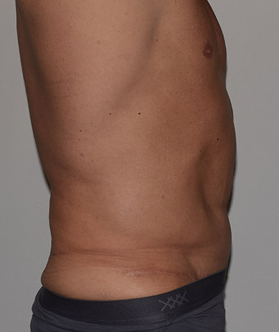 Tummy Tuck Before and After 07