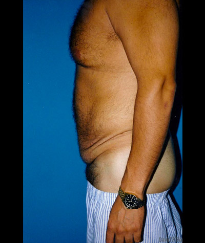 Tummy Tuck Before and After 08