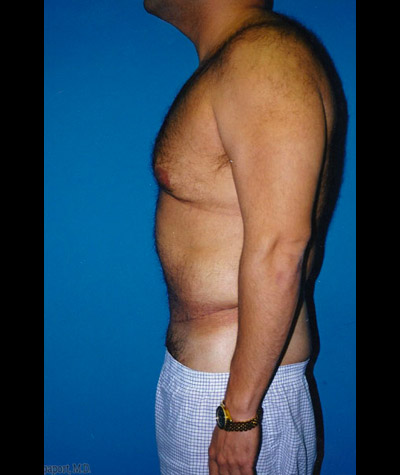 Tummy Tuck Before and After 06