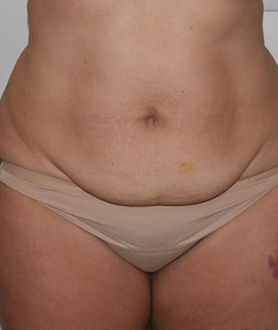 Tummy Tuck Before and After 10