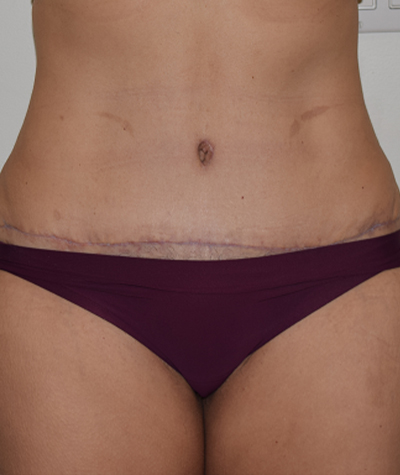 Tummy Tuck Before and After 06
