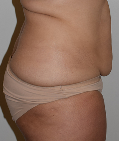 Tummy Tuck Before and After 10
