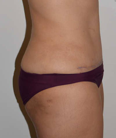 Tummy Tuck Before and After 10