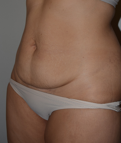 Tummy Tuck Before and After 10